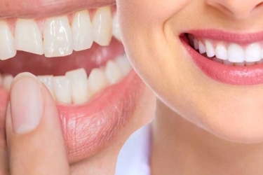 Dental Bonding Treatment in Meerut, Best Dental Clinic for Tooth Bonding, Cost of Dental Bonding, Best Dentist for Dental Bonding in Meerut, UP, Best Dental Centre for Tooth Bonding in Ganganagar, The Dental Roots