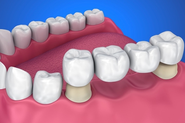 Best Dental Centre for Dental Crown in Meerut, Dental Bridge for Missing Teeth, The Dental Doctors, Ganganagar, Meerut, Cost of Dental Bridge in Meerut, Dr Astha Verma, Dr Shalabh Kumar