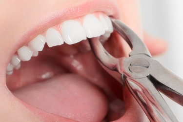 Dental Extraction in Ganganagar, Wisdom Tooth Extraction in Meerut, Best Dentist for Tooth Extraction, Cost of Tooth Extraction, The Dental Doctors, Meerut, Dr Astha Verma