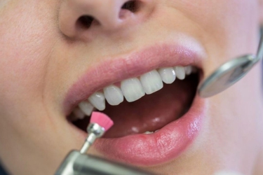 Scaling and Polishing Treatment in Meerut, Best Dental Clinic in Ganganagar for Scaling, Cost of Teeth Scaling and Polishing in Meerut, Dr Astha Verma Best Dentist for Scaling and Polishing 