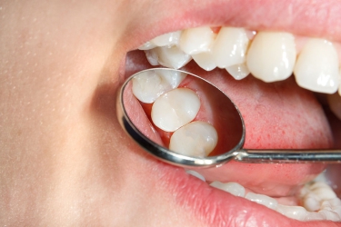 Tooth Cavity Filling in Ganganagar, Cost of Cavity Filling in Meerut, Composite Filling, Treatment for Decayed Tooth, Best dentist for dental cavity treatment, The Dental Doctors, Best Dental Centre in Meerut, Uttar Pradesh