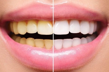 Teeth Whitening Treatment in Meerut, Teeth Cleaning in Ganganagar, Best Dentist for Teeth Whitening, The Dental Doctors, Best Dental Clinic in Meerut, Cost of Teeth Whitening Meerut, Uttar Pradesh