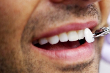 Dental Veeners Treatment, Best Dentist for Dental Veeners, The Dental Doctors, Best Dental Clinic for Veeners in Meerut, Best Dentist for Veeners in Uttar Pradesh, Cost of Veeners in Ganganagar